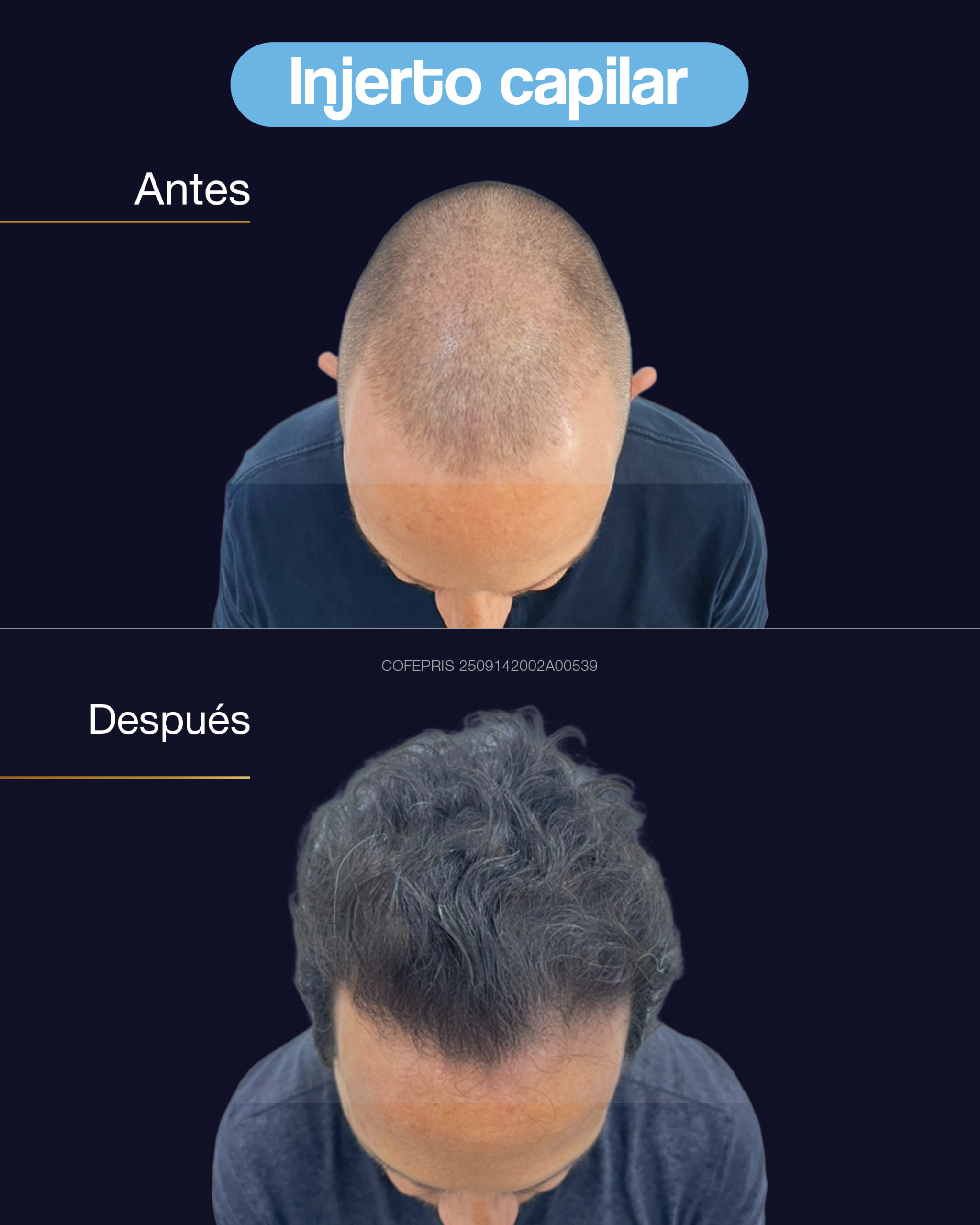 000008 - ANTES Y DESPUES INJERTO CAPILAR