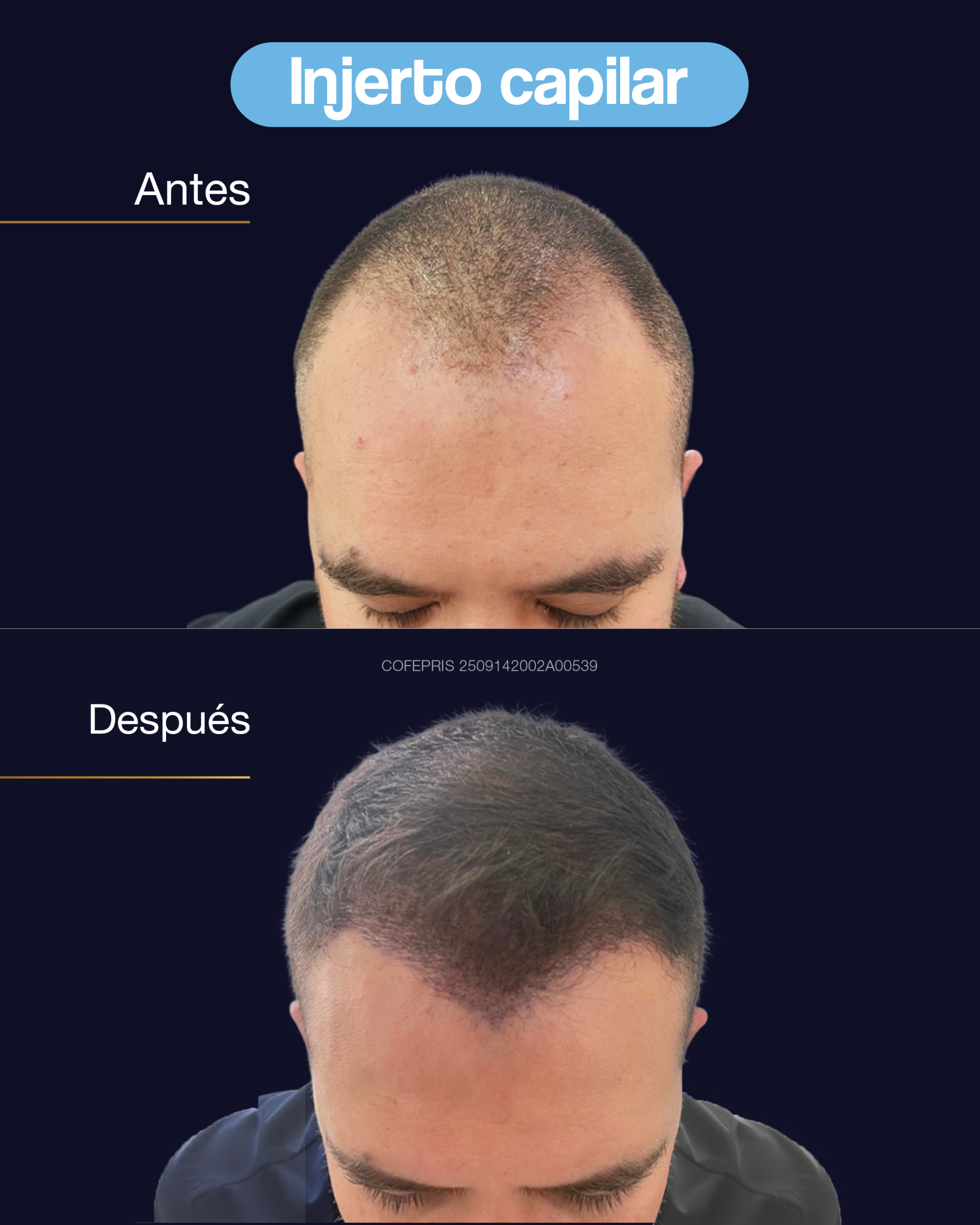 000009 - ANTES Y DESPUES INJERTO CAPILAR