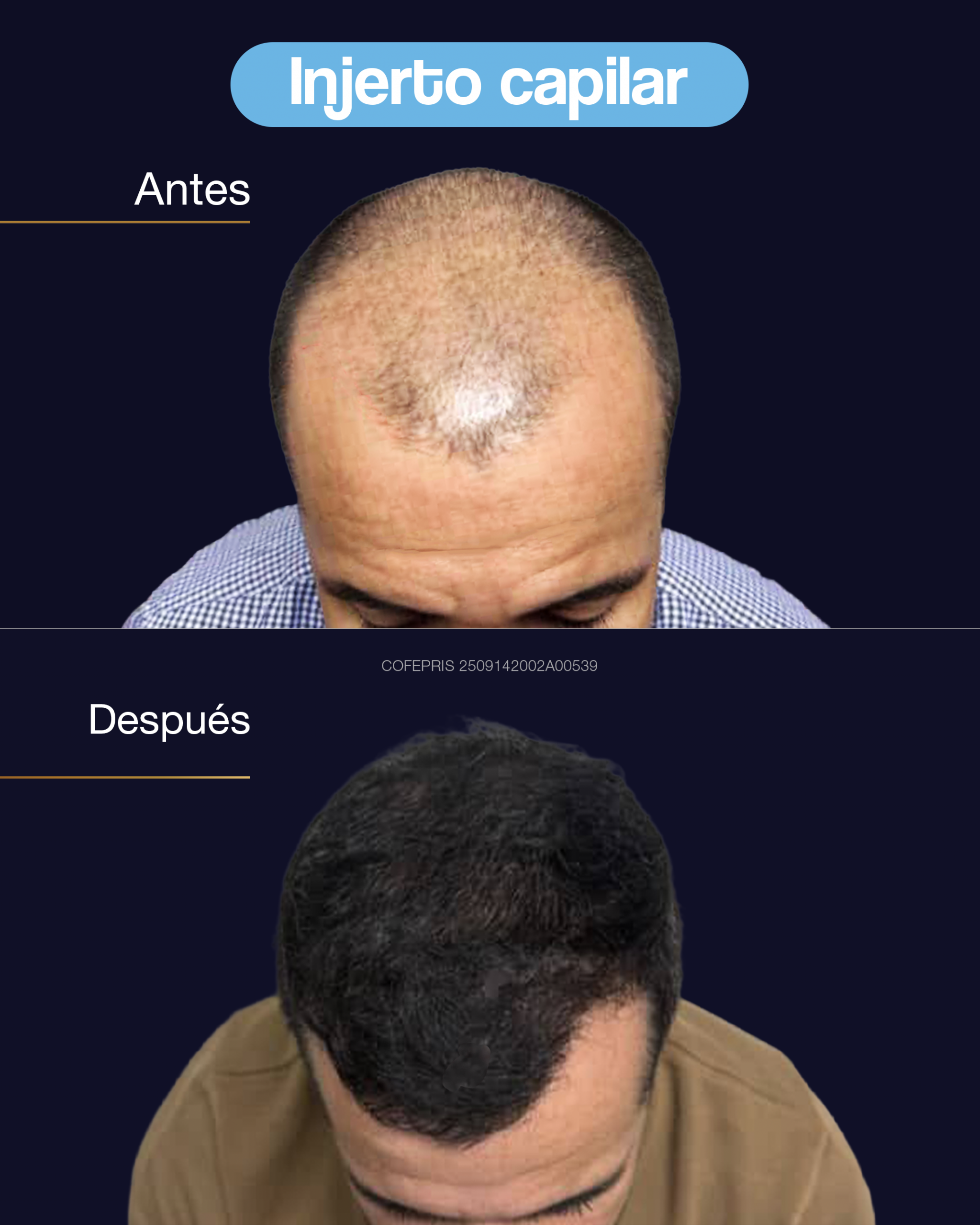 000010 - ANTES Y DESPUES INJERTO CAPILAR