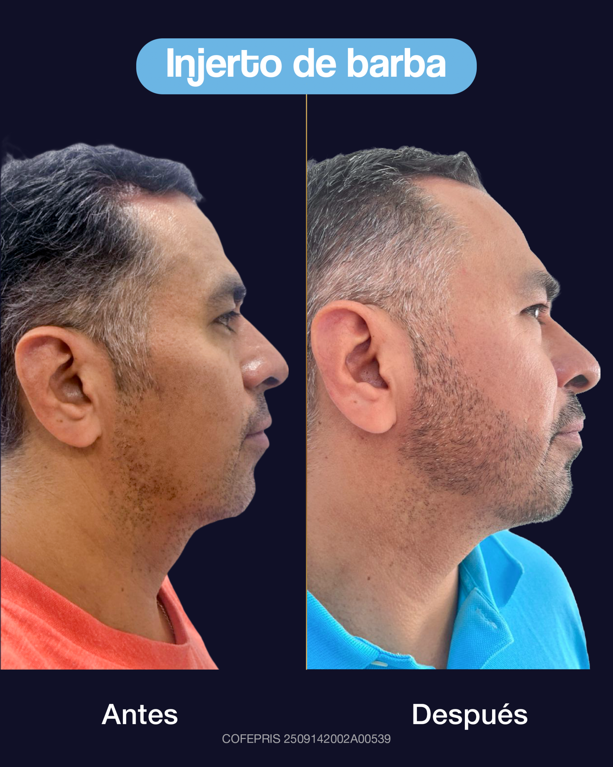 000012 - ANTES Y DESPUÉS INJERTO DE BARBA 003