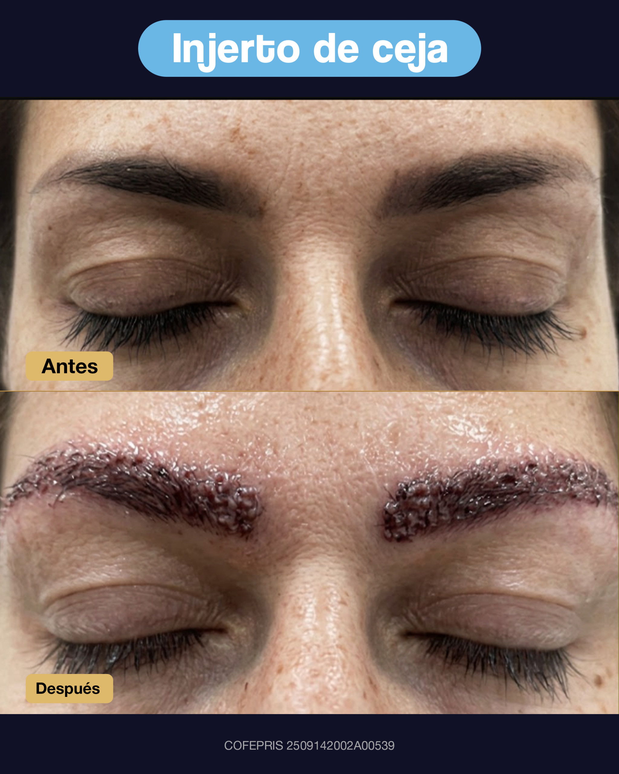 000014 - ANTES Y DESPUES INEJRTO DE CEJA