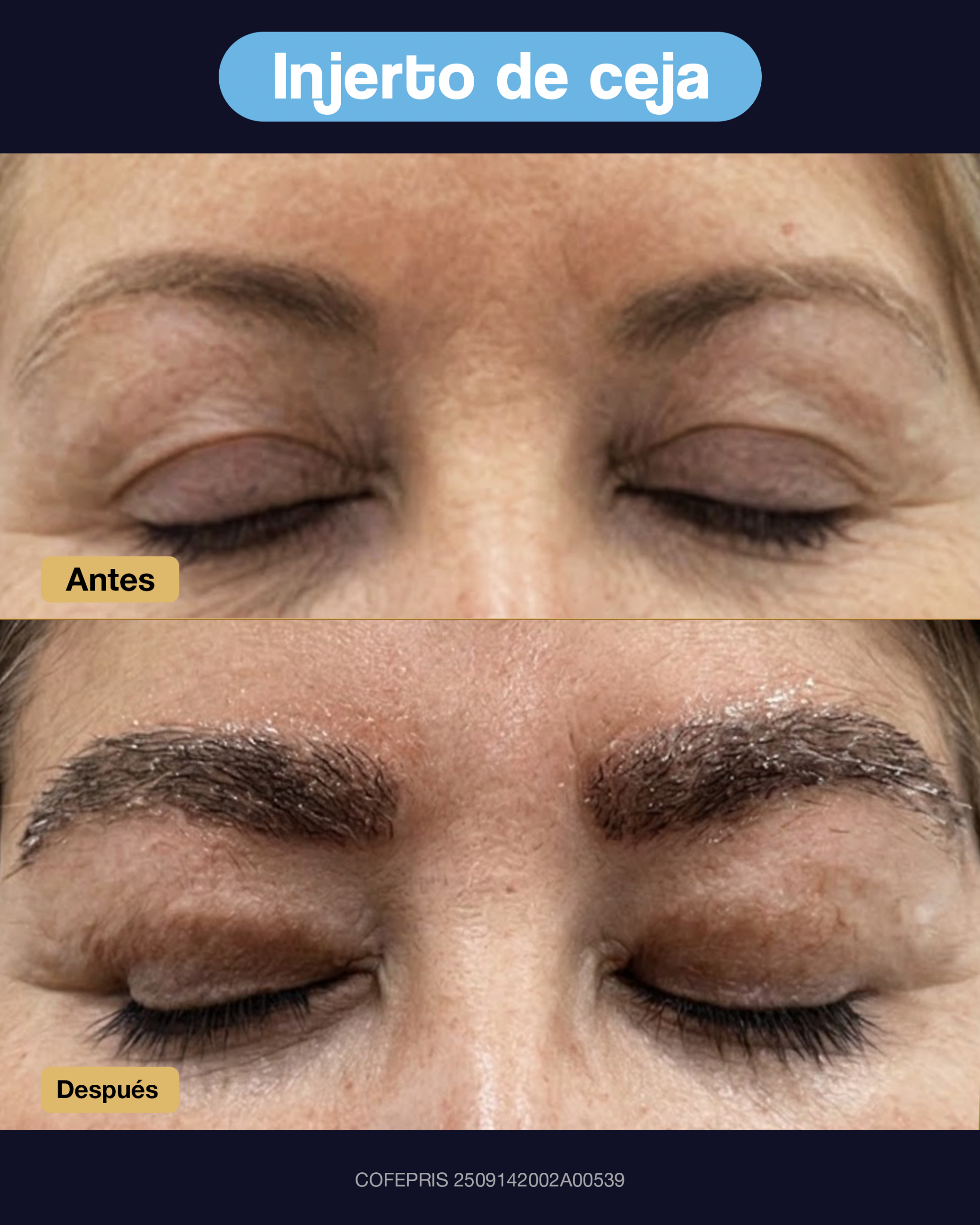 000015 - ANTES Y DESPUES INJERTO DE CEJA