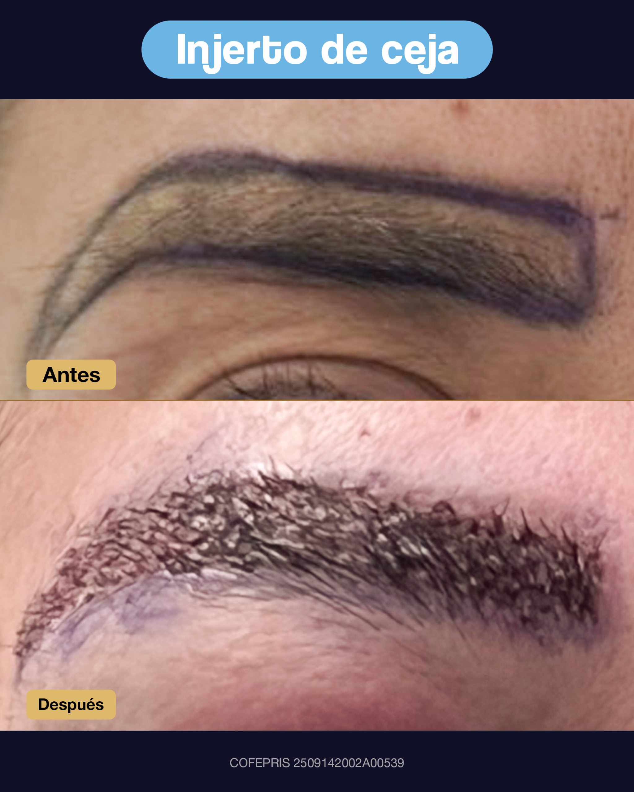 000017 - ANTES Y DESPUES INEJRTO DE CEJA