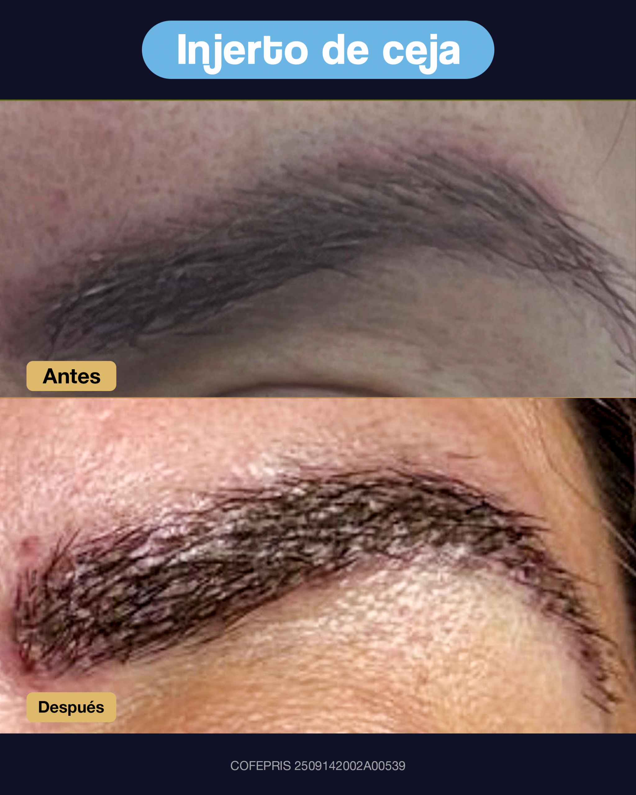 000018 - ANTES Y DESPUES INJERTO DE CEJA