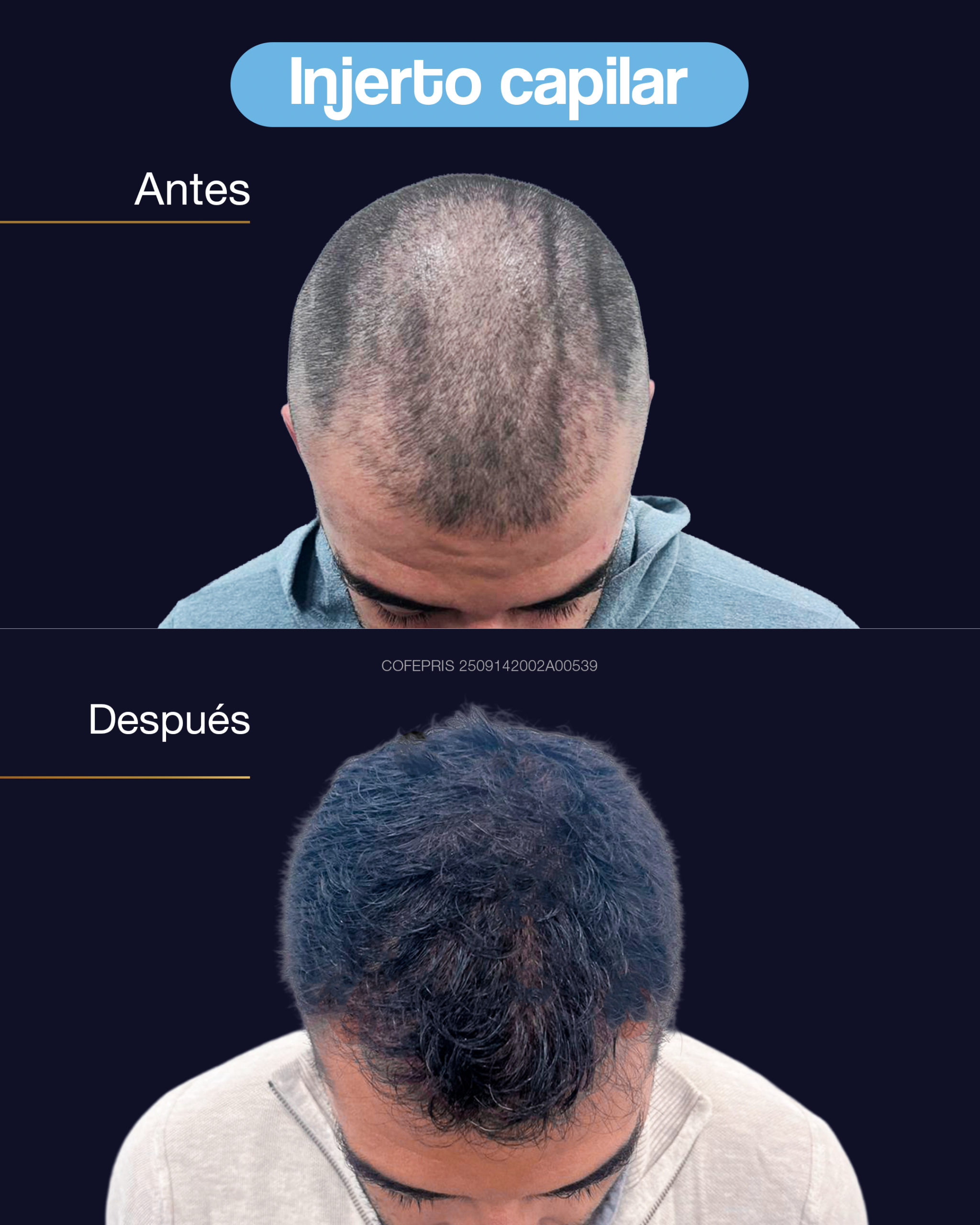 ANTES Y DESPUES INJERTO CAPILAR 02